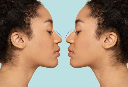 Rhinoplasty